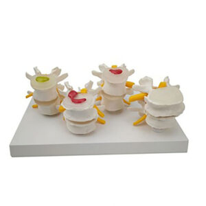 Modelo Combinado De Columna Vertebral Y Columna Lumbar